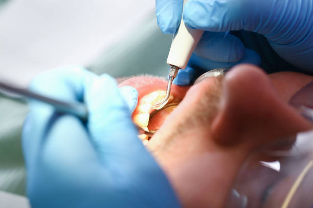 Best Chipped Tooth Repair Near Me  in Union Springs, NY